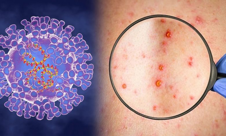 ১১ দেশে ছড়িয়ে পড়েছে মাঙ্কিপক্স